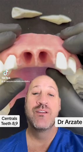 It's crucial to understand the importance of central teeth in the upper maxilla and how their loss can significantly affect bone structure and facial aesthetics in a patient. Central teeth not only play a fundamental role in chewing and phonetics but are also vital for maintaining the integrity of the surrounding alveolar bone. 🦷💪 When a patient loses central teeth, whether due to periodontal diseases, trauma, or other causes, it's essential to act promptly to preserve bone health and prevent 