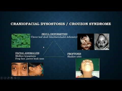 Brief discussion on Crouzon syndrome