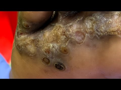 Jackson’s part B of the right foot - thick jigger clusters watch full video @riseupsociety.net