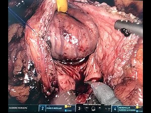 Robotic Transvesical Simple prostatectomy (Freyer's Procedure)