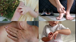 Itching Relief, Aloe Vera Gel Patch, Eczema, Sunburn, Psoriasis, Poison Ivy, Hives, Shaving Irritation, Hair Removal Irritation, Skin Care