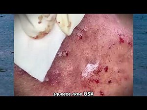 Extreme Pimple Extraction Gone Wild | New Pimple Popping Video 2025 #9 pimplepopping