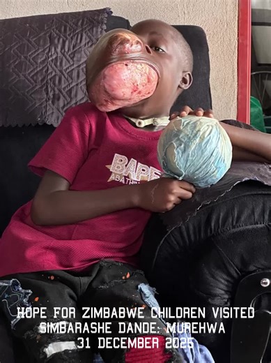 31 December 2025 : Hope for Zimbabwe Children visited Simbarashe Dande and family. We met his mother , two brothers and community. Simbarashe’s tumour has been bleeding. We bought groceries for him and family and gave his mother us20 to buy a ball for him. Simbarashe needs second surgery quoted in the USA at Mayo clinic for two hundred thousand dollars. Simbarashe plays football and is holding the ball he made using plastic papers. To help us help Simbarashe kindly check our profile. #hopeforzim