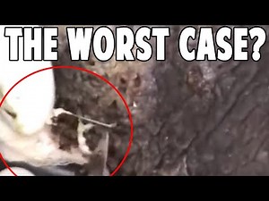 Nicholas' Egg Dig - Jiggers (AKA Foot Blackheads, Parasites) Similar To Mangoworms