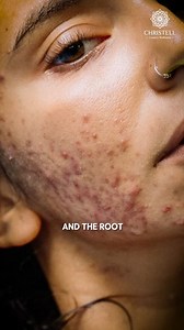 5.9K views · 14 reactions | Hey teens! Acne struggles got you down?  Let Dr. Pavithra help you understand why those pesky breakouts happen and how to kick them to the curb! Tune in for clear skin tips and confidence boosters!  . . #TeenAcneTalks #SkinConfidence #ChristellLuxuryWellness | Christell Skin Clinic | Facebook