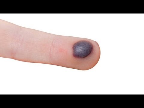 How to get Rid of Blood Blisters