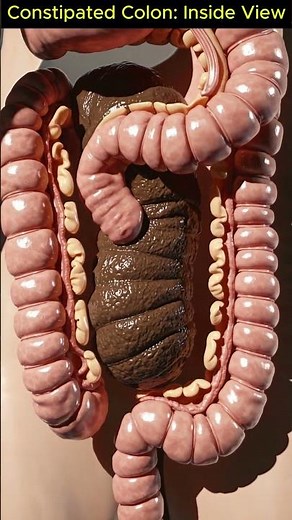 What Constipation Really Looks Like: Realistic 3D Colon Footage You’ve Never Seen | 08