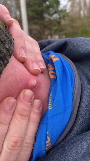 Neck pimple pop #pimple #acne #pimples #blackheads #pimplepopping #skincare #blackhead #pimplepopper #whiteheads #pimplepoppers #whitehead #blackheadextraction #blackheadremoval #cyst #pimplepop #drpimplepopper #pimplesremover #zit #pores #skin #whiteheadextraction #drsandralee #beauty #acnetreatment #cystremoval #zits #whiteheadremoval #jerawat #skincareroutine #pimpleremover