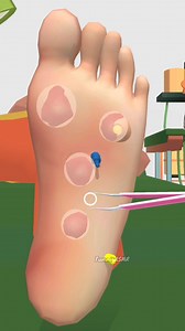 Leech Remove Spot Pain Foot Care #animation #asmrvideo #shorts #footcare #fbreelsfypシ゚viralシ #SatisfyingVideos #fbreelsfypシ゚viral #cleaning #treatment #facebookreelsviral #shortsreels #leech #painrelief #fbreelsfypシ゚ #reelschallenge #reelstrending #reelsfypシ #trendingreels #facebookreel #trend #viralreelsシ #fb Tunnig ASMR | Tunnig ASMR