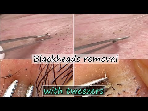 Blackheads removal under nose with tweezers