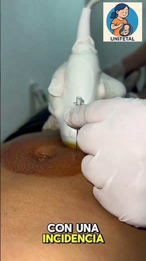 Risks of amniocentesis. #amniocentesis #unifetal #pregnancy #perinatology #maternalfetal #bar