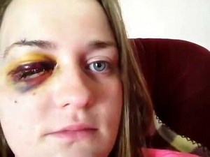 Removed bandage from Eye removal