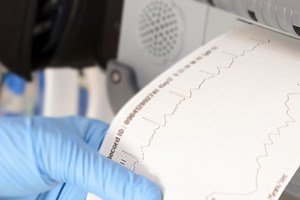 Atrial fibrillation: causes, symptoms and treatment