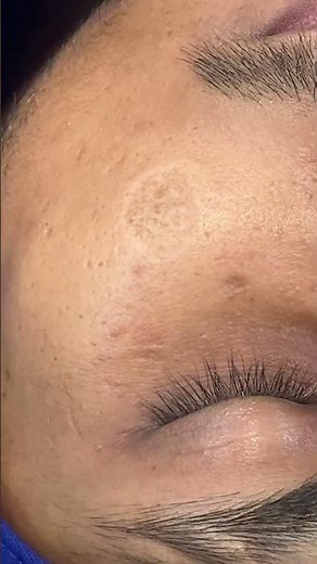 Large round dis coloured scar on the left cheek removed - revised