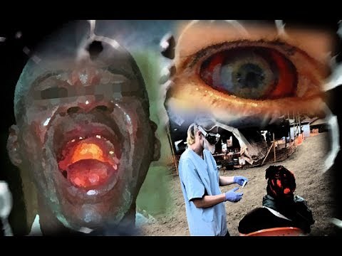 Ebola Virus Disease Lecture-13 EVD: SIGNS & SYMPTOMS | BiologyCoachOnline | Jonathan Jeffreys