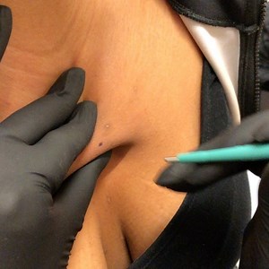 1.9K views · 16 reactions | Chest dermal  #microdermal #dermalpiercing #anchorpiercing #piercings | Underground Tattoos Enfield | Facebook