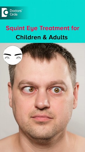 SQUINT EYE TREATMENT for Children & Adults #Squint #strabismus #lazyeye #eyecare | Doctors' Circle