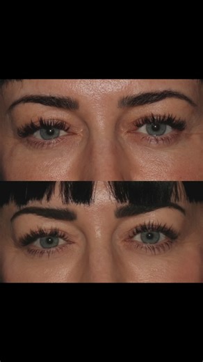 Jennifer has been so amazing to document her entire PRF journey with us and we’ll share some of her swelling and healing too, but I wanted you to see her results and hear what she thought of the results. Why we use PRF injection part 4: PRF gel is a 100% natural biostimulating injectable that utilizes the body’s natural proteins and growth factors to improve skin tone and texture while treating deep tear troughs, lines and wrinkles, volume loss, and more. Our nurses draw your blood and separate 