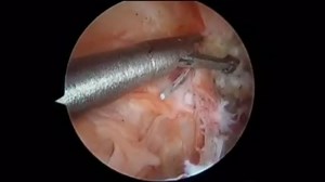 Arthroscopic technique for distal tibial allograft bone augmentation with suture anchor fixation for anterior shoulder instability - Mayo Clinic