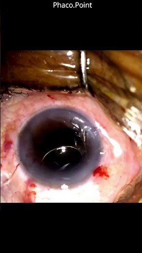 How to implant a rigid IOL into the Capsular Bag after SICS