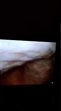 Cystoscopy in a man, who came with difficulty urinating Painless simple procedure