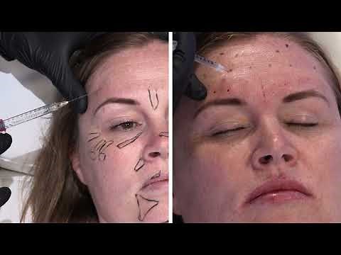 When BOTOX isn't enough. When you should use filler for DEEP forehead lines!