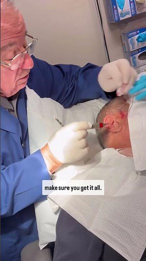 Dermatologist with 50 Years Experience Removes Large Cyst on Face (part 3)👨🏻‍⚕️