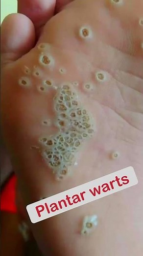 Trypophobia or plantar warts? #shorts