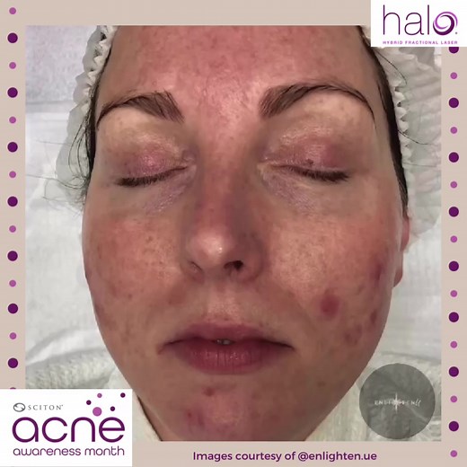 We’re waving adult acne goodbye! During #AcneAwarenessMonth, we’re highlighting why our products are the ones you want for all things acne. HALO targets all different types of acne scars as the setting are customizable for every treatment, allowing providers to adjust the depth and density of the settings based on the patient’s needs. Click our link in bio to find a HALO provider near you | Sciton, Inc. | Facebook