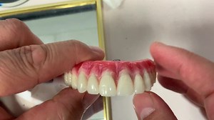 5 implant wax try in for hybrid denture case! Case from Dr Samantha Chou in Chicago! | LSK121 Oral Prosthetics | Facebook