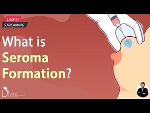 What Is Seroma Formation?
