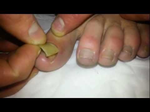 Removal of Dead toenail!!!