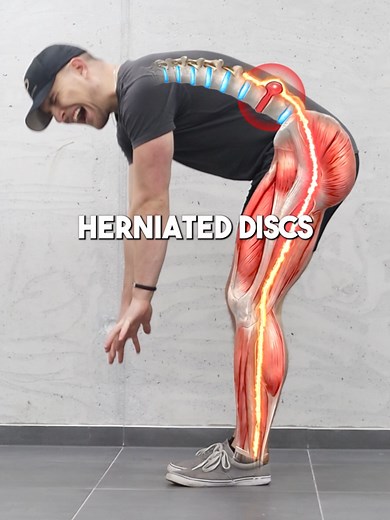 Understanding Herniated Discs and Healing Process