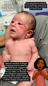 When a doctor snaps fingers beside a newborn’s ear and the baby does not react, it means the startle/ auditory reflex is not present. When the doctor waves a finger across the baby’s eyes and the baby does not blink, it means the visual blink reflex is also absent. #newborn # | Mabel Learning Corner For All