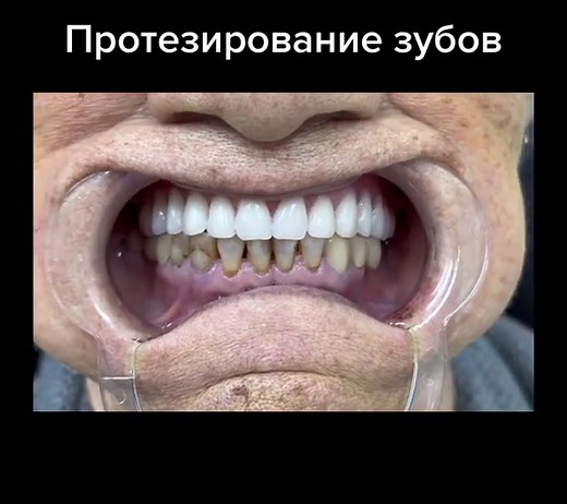 протезирование зубов #алматыстоматологицескийцентр #стоматология #рек #протезированиезубов #тренды #кариес #стоматологалматы #брекетыалматы #алматыстоматология #кариесзубо