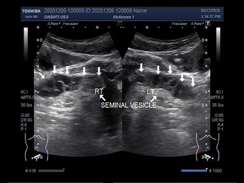 Ultrasound Video showing enlarged seminal vesicles.