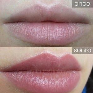 Permanent Lip Color Tattoo in Istanbul Turkey