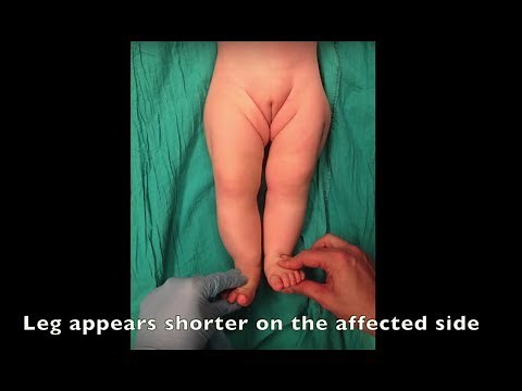 Barlow and Ortolani tests