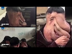 China's Elephant Man : Huang Chuncai, 39 : World's Biggest Facial Tumour