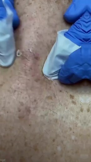 Pimple popping compilation #pimplepopper #extractions #pimple #skincleaning #acnefighter #pimpl #fy
