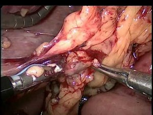Laparoscopic Limited Gastric Resection  • Video • MEDtube.net