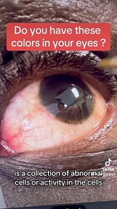 ✅Do you have these in your eyes?✅ #eyereading #iridology | Raw Maraby
