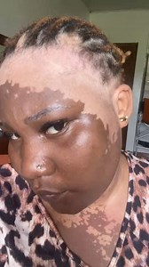 What causes vitiligo? Video credit: Thevitiligogirl/Tiktok | Elizabetholu