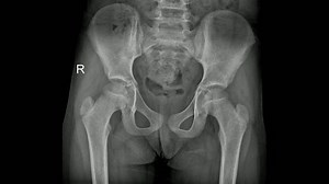 Medical X-ray Human Child Pelvic Bones Stock Footage Video (100% Royalty-free) 3654874949 | Shutterstock