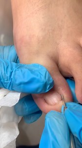 131K views · 860 reactions | Extreme Toenail Cutting – Deep Clean Transformation!#ToenailCutting #SatisfyingVideo #FootCare #CleanFeet #NailCare | ADN Medical | Facebook