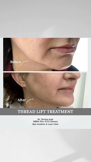 Timeless Elegance: Before and After Thread Lift Transformation! ✨ Watch the subtle yet stunning changes achieved with Thread Lift by Dr. Neelam. Elevate your beauty, gracefully. Consult today!🌟 Contact us ☎️ 051 8737740 🏣 3rd Floor, Union Gold Mall, F-7 Markaz, Islamabad . . . #drneelamayub #dermatologist #EmbraceRF #contouredjawline #aestheticphysician #doctor #skinclinic #skin #Facelifting #neelamayub #MoleRemoval #DrNeelamMagic #CustomizedSolution #ThreadLiftTransformation #TimelessBeauty |