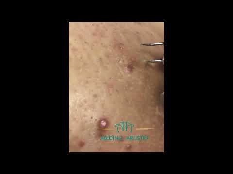 Real Client, Real Relief — Deep Ingrowns Removed with Care | Ep. 8