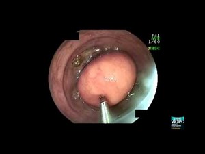 Colonic Lipoma • Video • MEDtube.net