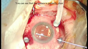 Vitrectomy in an Eye With DSAEK Graft - Eyetube