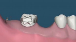 Molar Distalisation #Dentistry #LearningTips #BitesnBraces #Dentist #Dental #dentista #Teeth | Dr. Syed Naveed Manzoor
